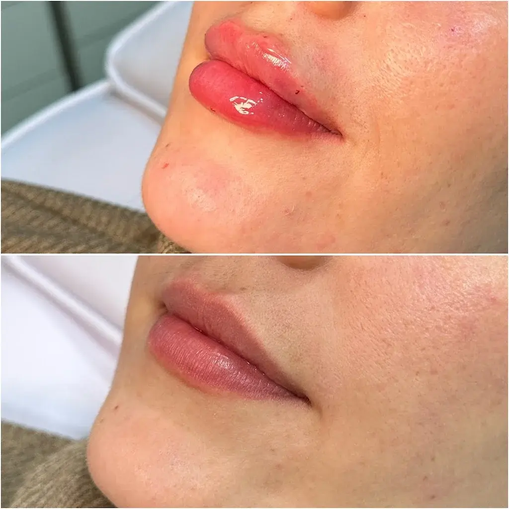 Resultado de preenchimento labial