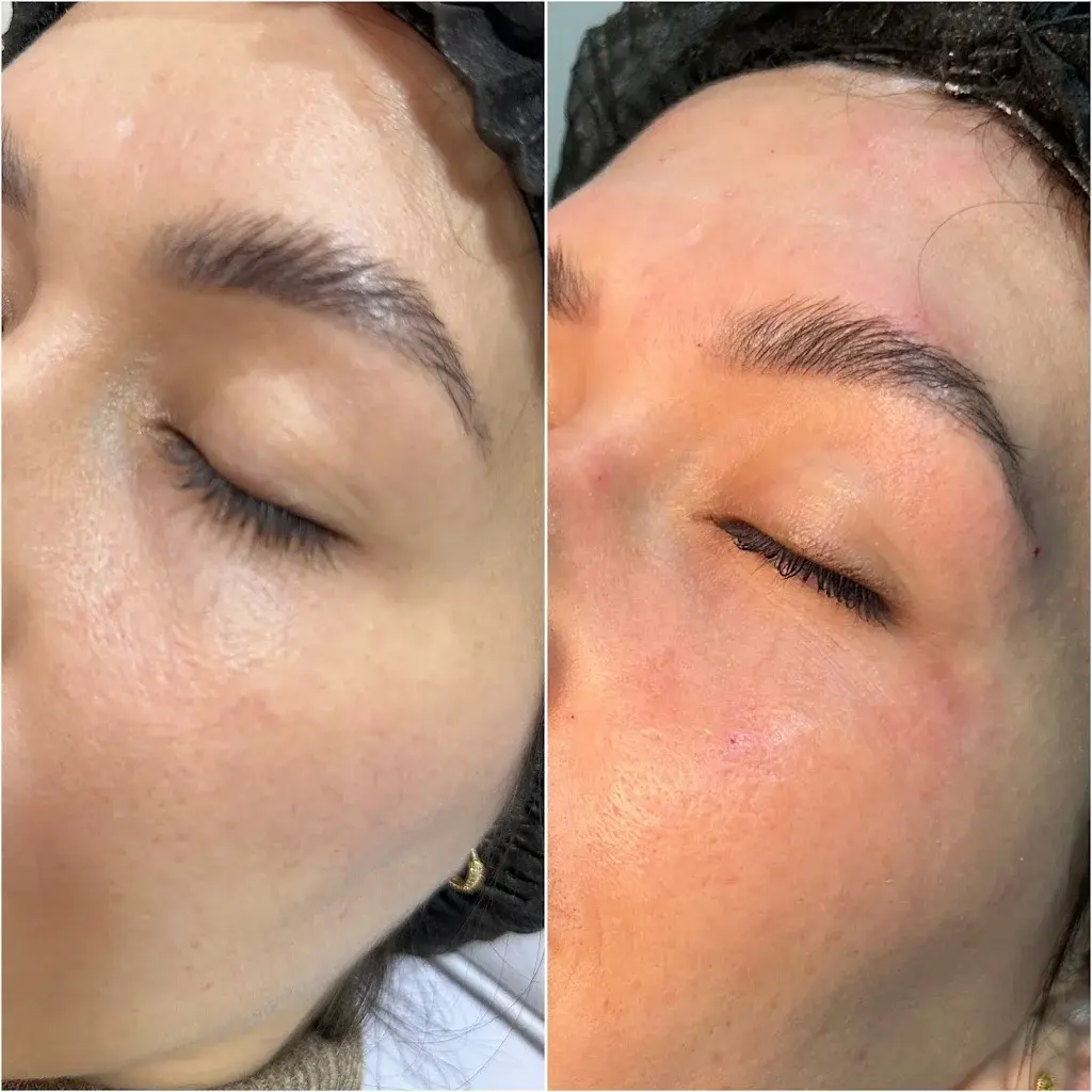 Resultado em região dos olhos
