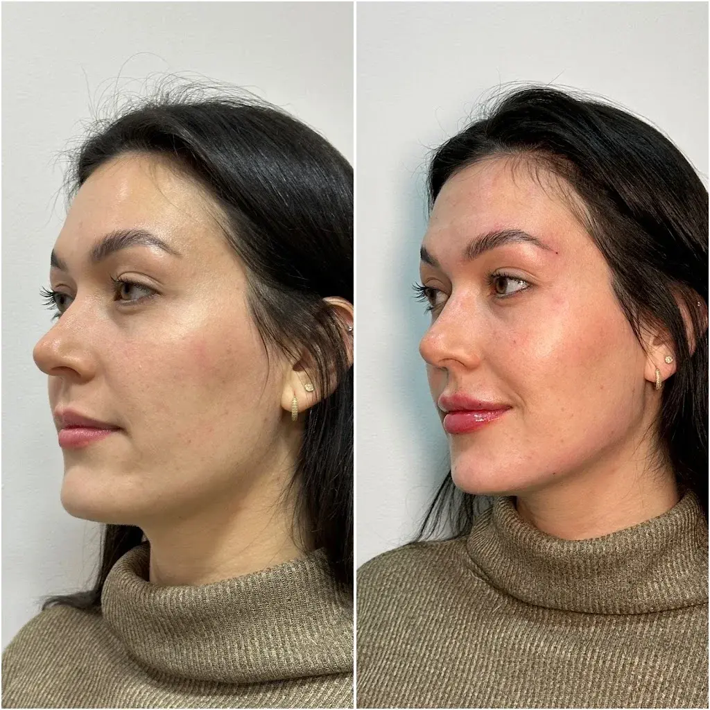 Resultado de harmonização facial